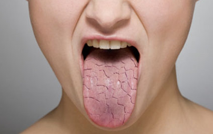 #10 THE DRY MOUTH EPIDEMIC