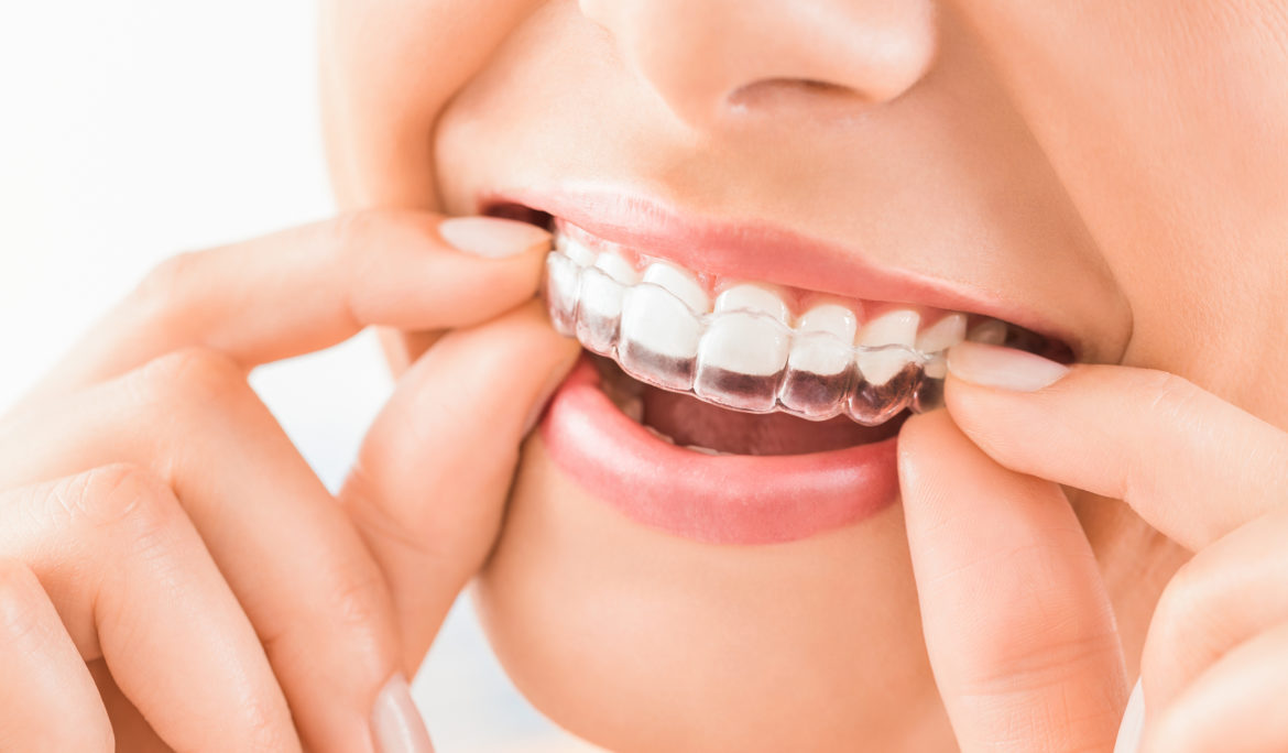 INVISALIGN, WHAT IS IT AND HOW CAN IT IMPROVE MY HEALTH? BLOG #52