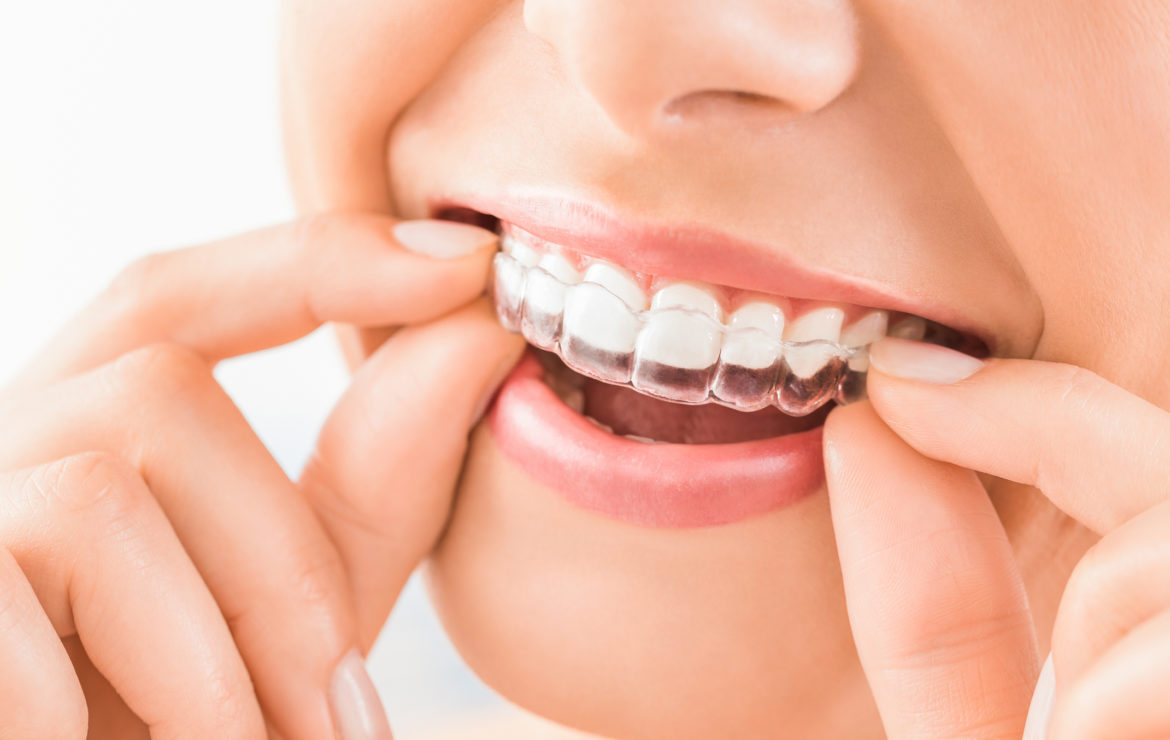 INVISALIGN, WHAT IS IT AND HOW CAN IT IMPROVE MY HEALTH? BLOG #52