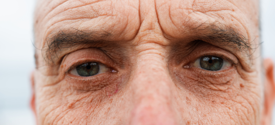 CAN SUGAR CAUSE WRINKLES?